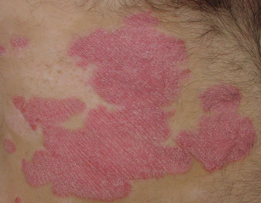 Psoriasis awareness month: Profiling the latest treatment methods to prevent the disease