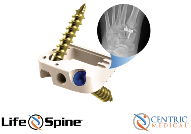 Life Spine begins clinical study of Tarsa-Link system