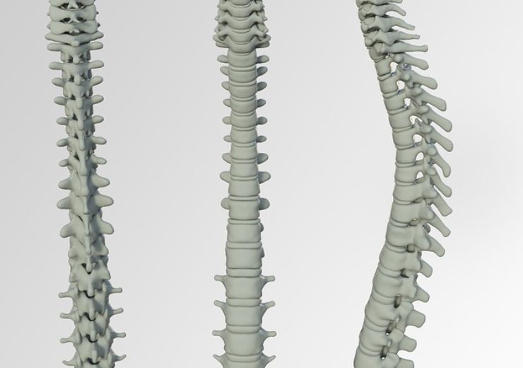 Ozop Surgical announces exclusive licence agreement with Spinal Resources for spinal implants