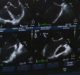 SofWave Medical’s secures FDA approval of new Ultrasound Technology