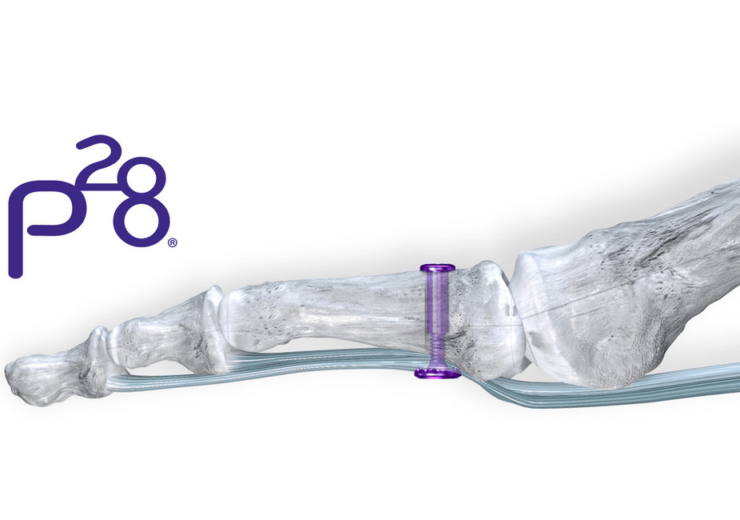 Paragon 28 launches sterile kit configuration to streamline delivery of first-of-its-kind hammertoe and plantar plate repair solution