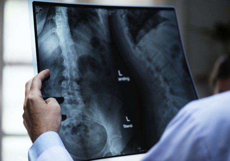 Outcomes of Spineology US clinical trial for interbody fusion