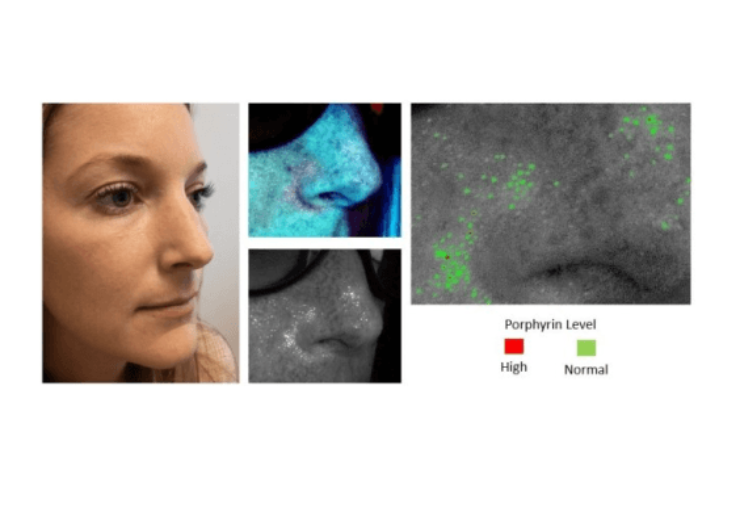 Galileo Group introduces ARMADA UV smartphone-based skin follicular oil / sebum image detection technology