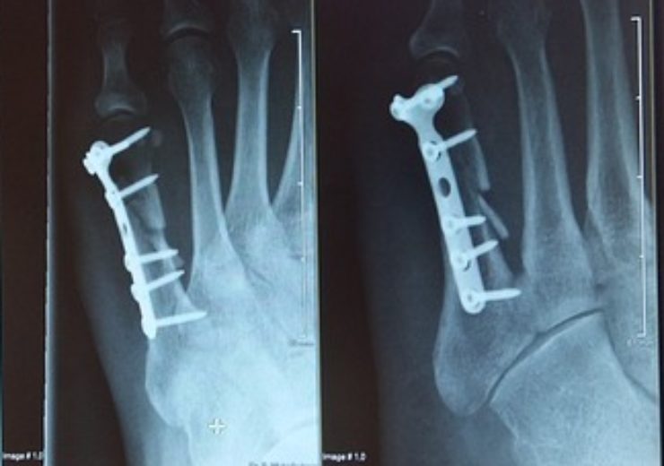 Silver Bullet Therapeutics secures CE Mark approval for new antimicrobial bone screw system