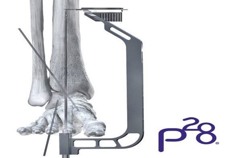 Paragon 28 gets FDA 510(k) clearance for Paratrooper plantar plate system