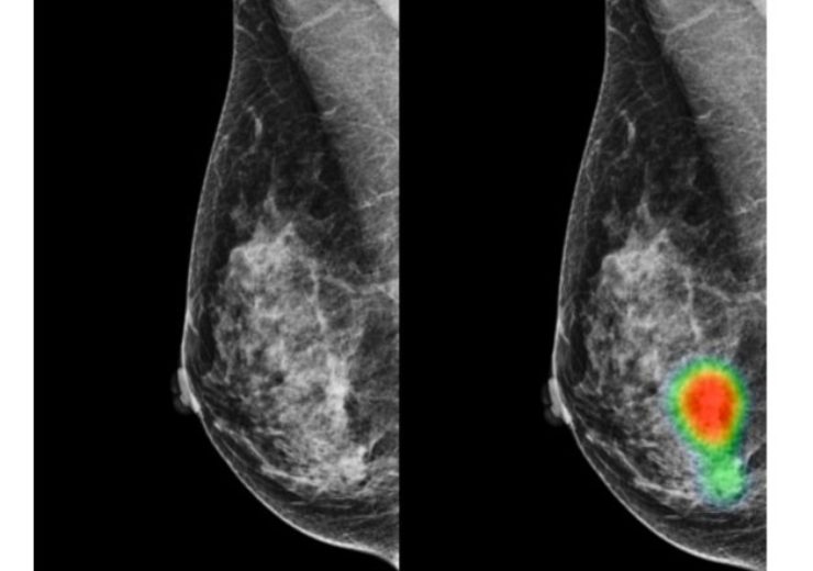AI-assisted radiologists can detect more Breast Cancer with reduced false-positive recall