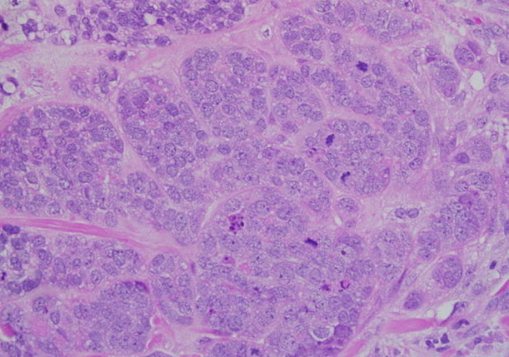 638px-Invasive_Ductal_Carcinoma_40x