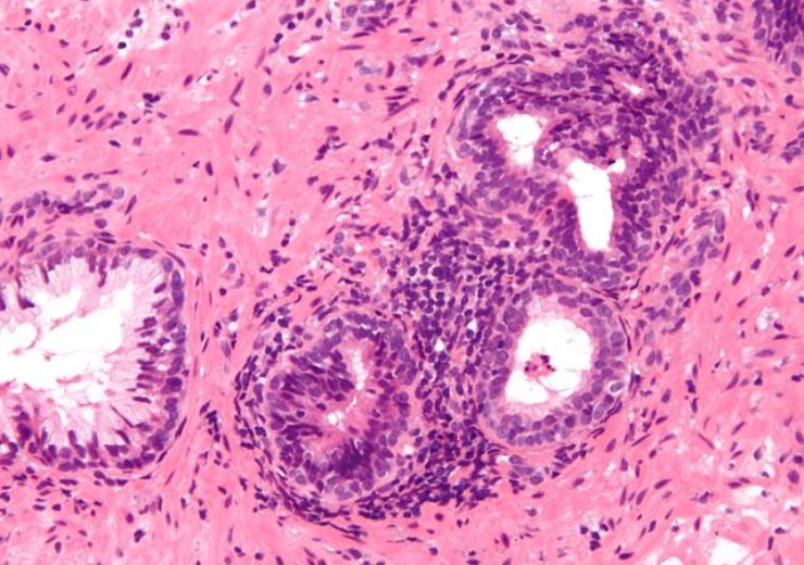 Nanospectra Biosciences initiates pivotal study of AuroLase therapy for ablation of prostate tissue