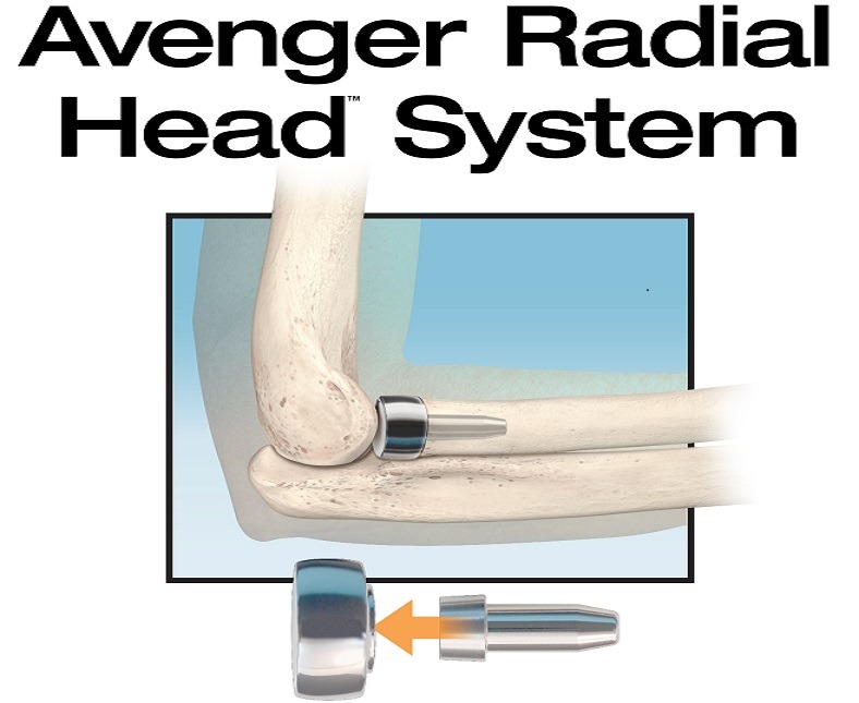 In2Bones launches Avenger system for radial head replacement surgery in US