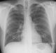 Paragonix gets FDA nod for LUNGguard donor lung preservation system