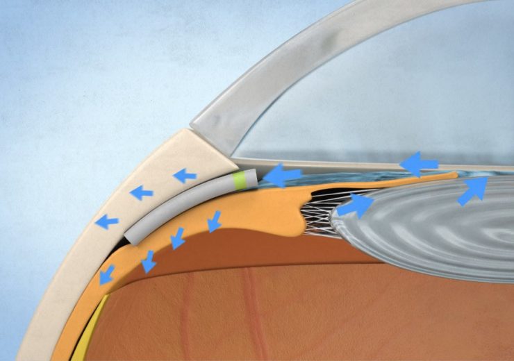 First truly biocompatible MIGS implant from iSTAR Medical shows consistently outstanding efficacy in patients with glaucoma
