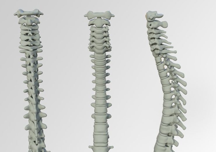 Life Spine announces initial cases with DYNA-LINK Ti stand-alone ALIF spacer system