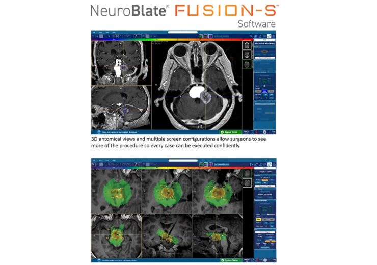 Monteris announces FDA clearance of NeuroBlate Fusion-S software