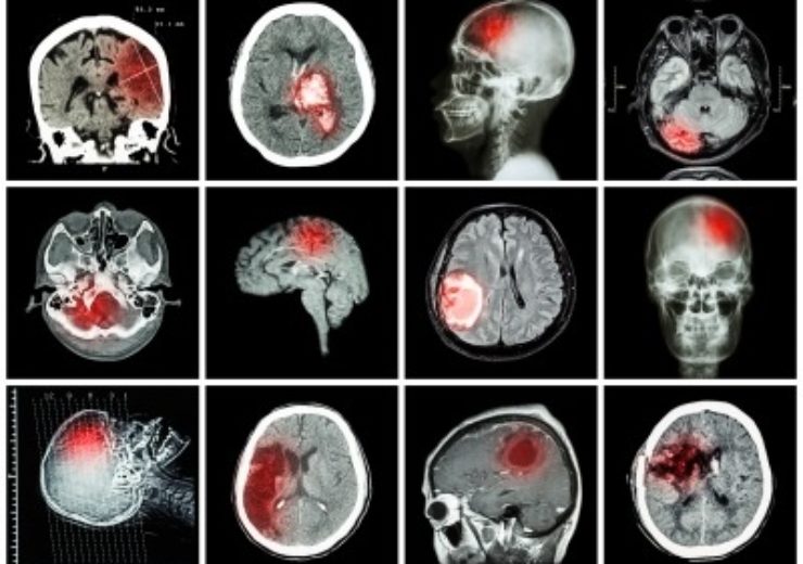 Rapid ASPECTS is first ever neuroimaging solution to receive CADx clearance from FDA