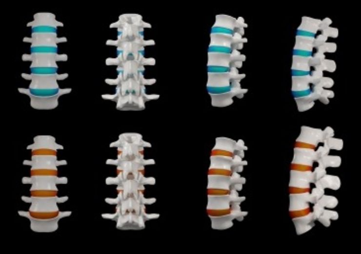 Life Spine announces initiation of the PROLIFT lateral expandable system outcomes study