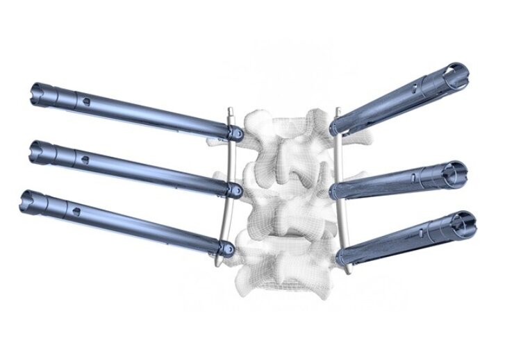 CoreLink expands minimally invasive portfolio with Tiger MIS extended tab pedicle screw system