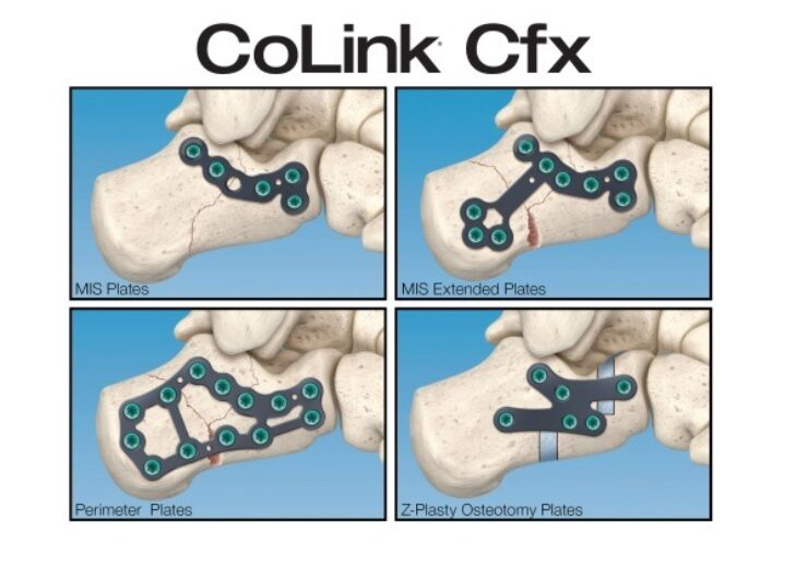 In2Bones launches CoLink Cfx calcaneal fixation system in US