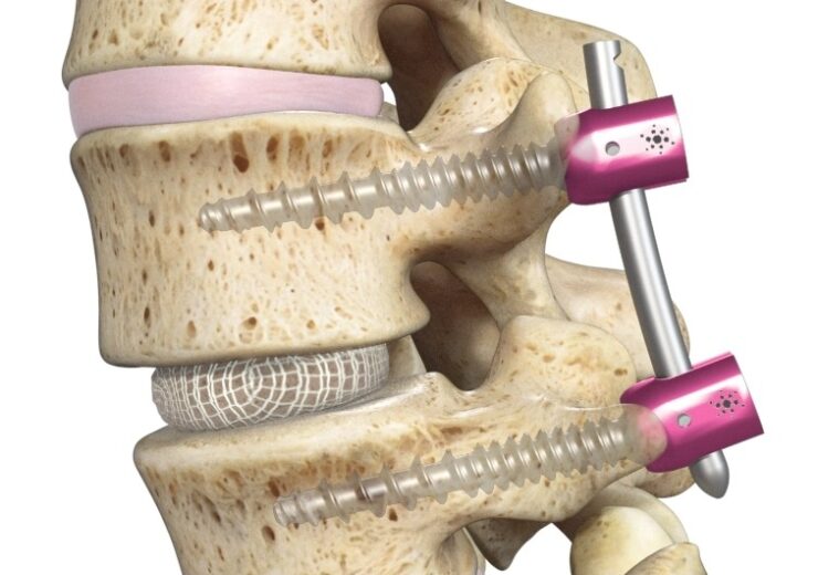 Spineology announces FDA De Novo Grant of minimally invasive OptiMesh expandable interbody fusion system