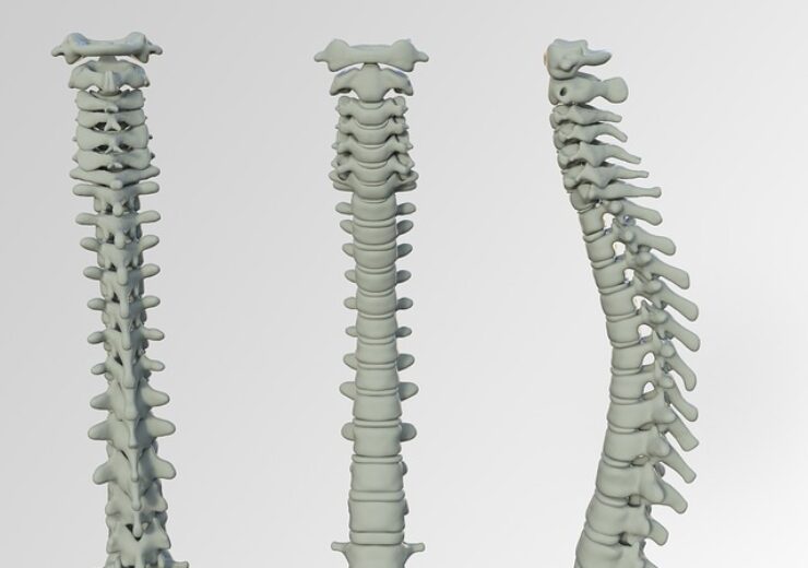 Spine Wave announces commercial launch of Tornado bioactive bone graft matrix