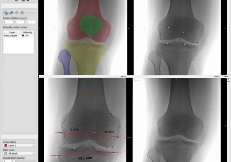 RSIP Vision launches new knee segmentation and detection from X-ray module