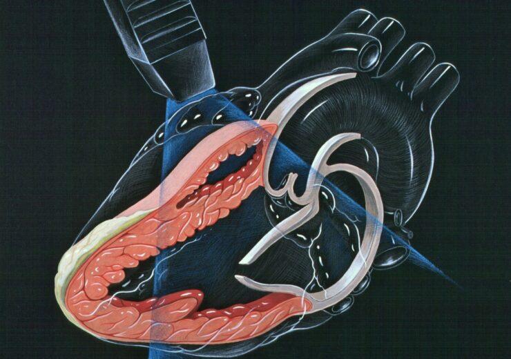 1194px-Heart_lpla_echocardiography_diagram