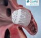 Conformal Medical’s CLAAS stroke prevention technology announces promising clinical results at 2020 TCT Conference