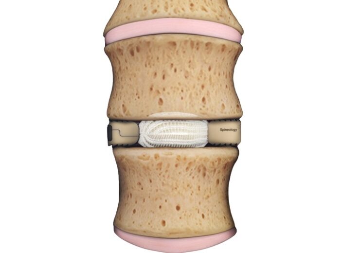 Spineology completes enrollment in post-market study of novel, expandable lateral implant