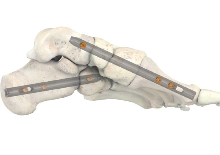 Stryker’s T2 ICF Nail System offers new option for patients with serious foot conditions