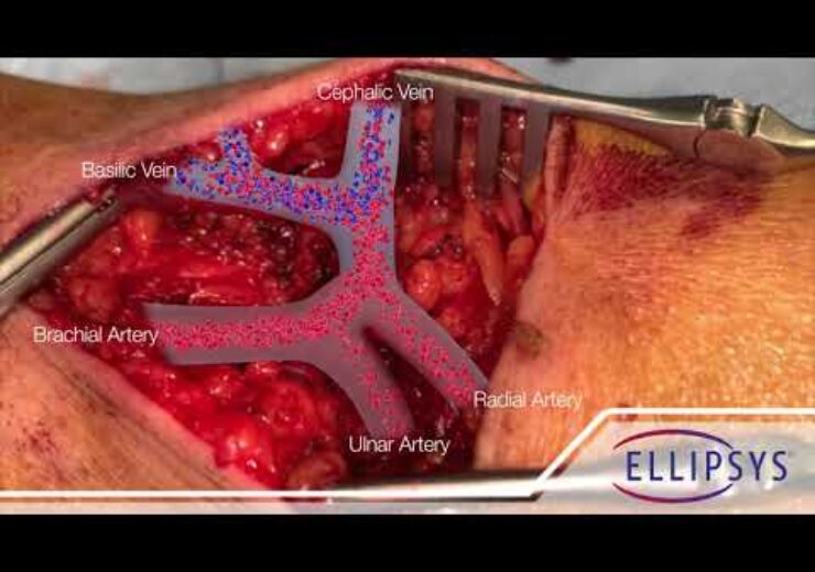 Minimally Invasive Ellipsys System creates fused, permanent vascular access for dialysis