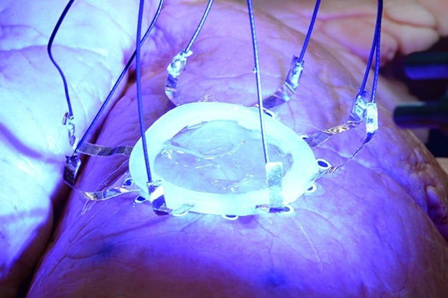 electronic sensors on expanding organs lungs