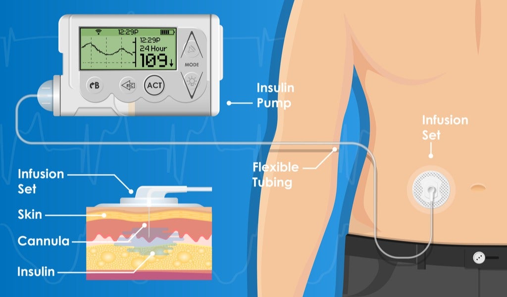 medical devices for diabetes