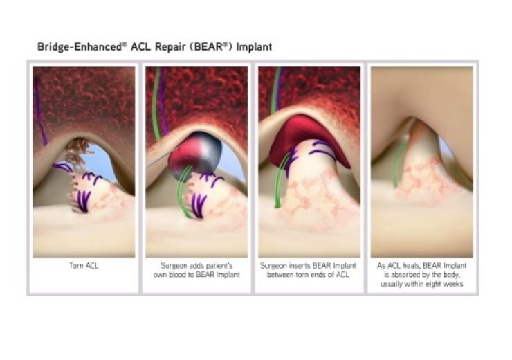 Miach Orthopaedics gets FDA approval for BEAR implant to treat ACL tears