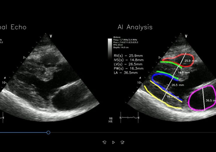 RSIP Vision announces new cardiac diagnostic tool for point-of-care ultrasound screening