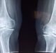Osteopore and Maastricht UMC+ develop bioresorbable bone implant