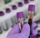 Gene-Based Blood Test for Melanoma Spread Evaluates Treatment Progress