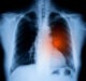 New study shows Parsortix liquid biopsy can detect drug resistance in lung cancer cells