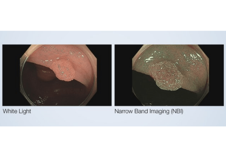 FDA approves Olympus’ Narrow Band Imaging to assess colonic lesions