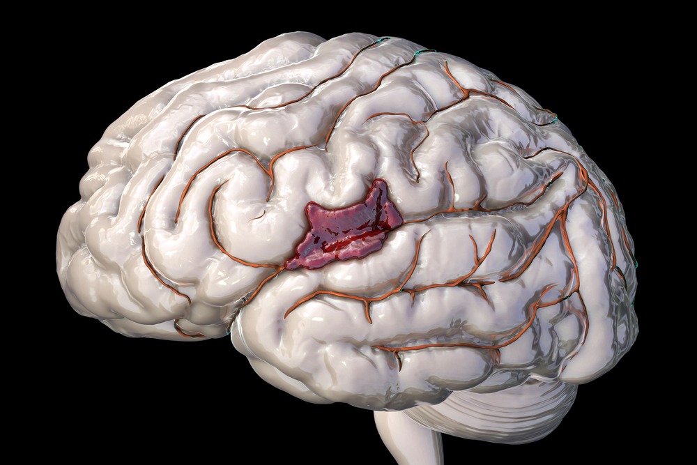 Мозг без крови. Геморрагический инсульт 3д модель.