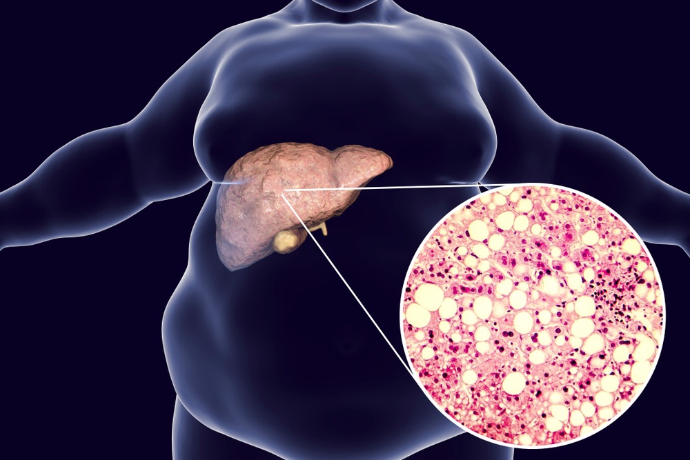 Liver-on-a-chip device could help researchers model advanced non-alcoholic fatty liver disease