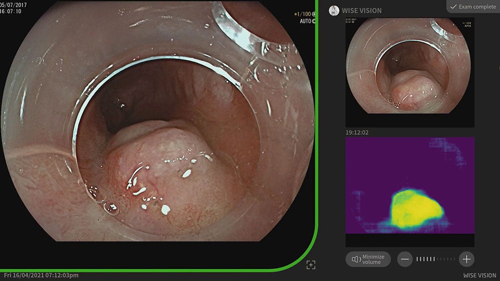 NEC develops AI technology to detect neoplasia in Barrett’s esophagus