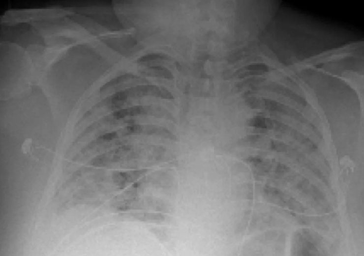 AI system predicts Covid-19 complications with 80% accuracy using chest X-rays