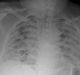 AI system predicts Covid-19 complications with 80% accuracy using chest X-rays
