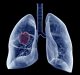 AI prediction tool foresees lung cancer development with equal accuracy to clinicians