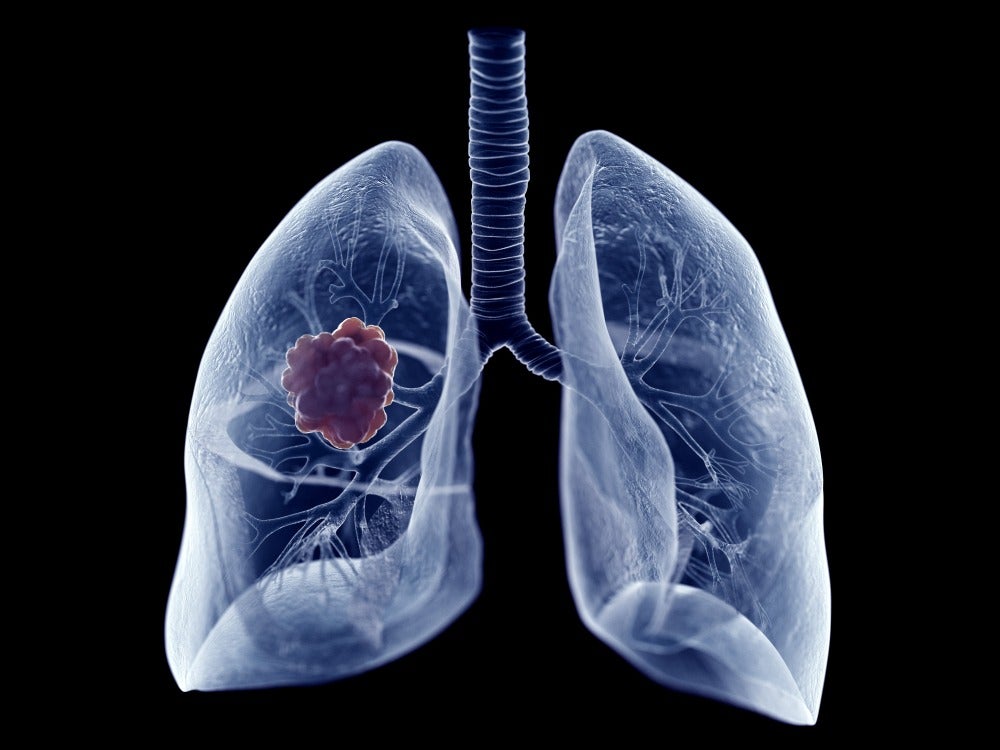 AI prediction tool foresees lung cancer development with equal accuracy to clinicians