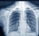 AI system used to detect chest abnormalities in X-rays receives CE mark