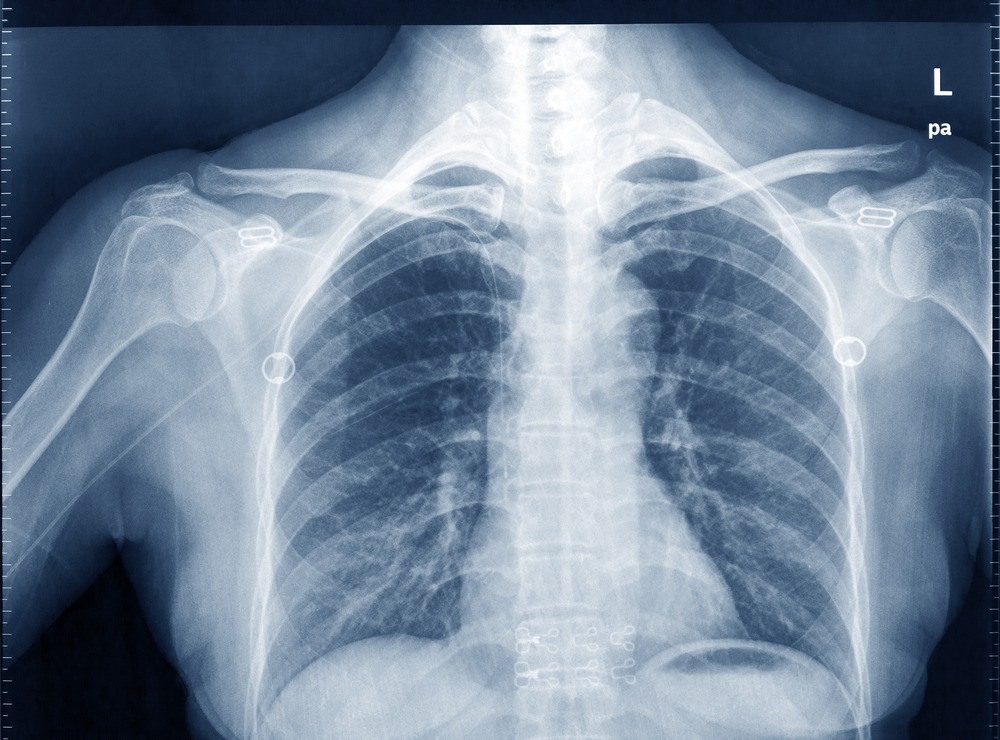 AI system used to detect chest abnormalities in X-rays receives CE mark