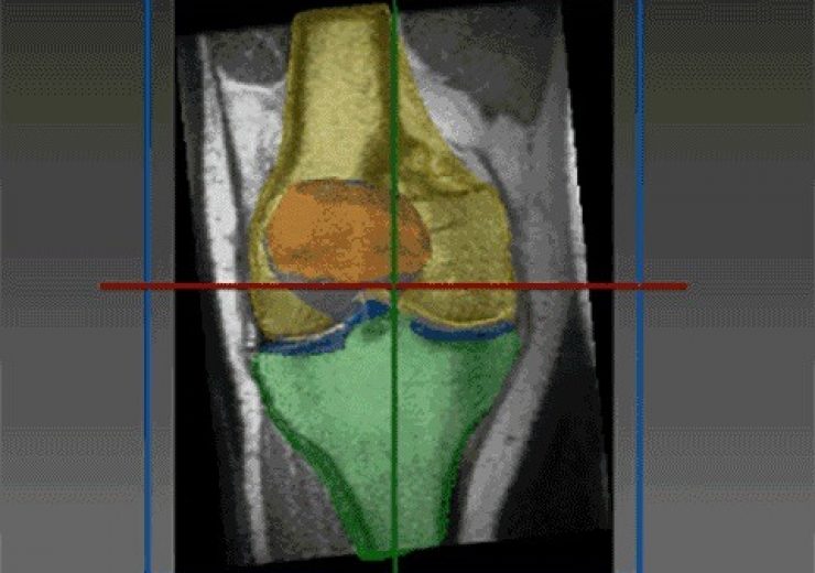 RSIP Vision introduces new articular cartilage segmentation tool