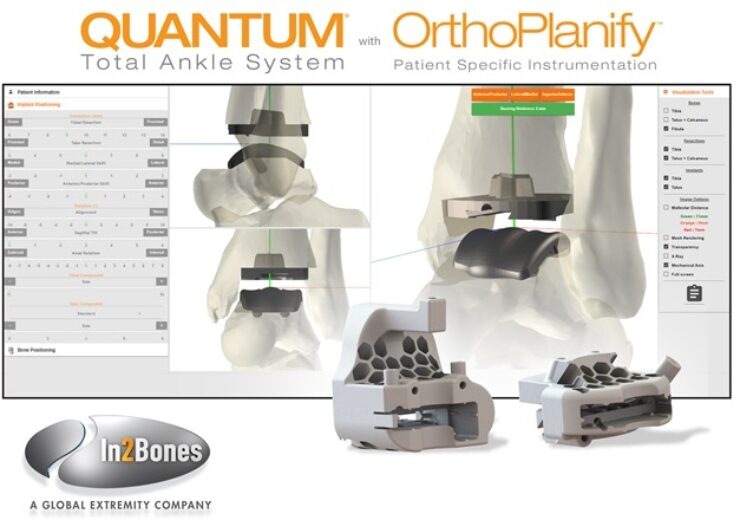 In2Bones Receives FDA Clearance for Pre-Surgery OrthoPlanify Patient-Specific Planning Software and 3D-Printed Cutting Guides for QUANTUM Total Ankle System