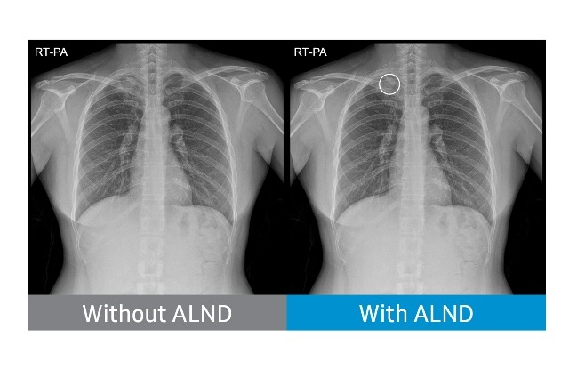Samsung’s NeuroLogica gets FDA nod for lung nodule detection tool