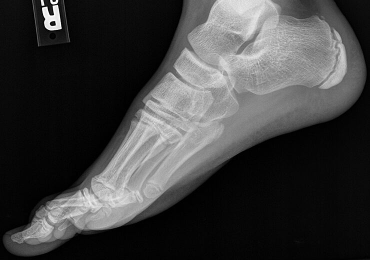 989px-X-ray_of_a_normal_foot_of_a_12_year_old_male_-_lateral